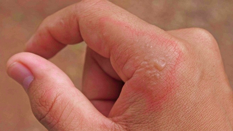 impetigo pada anak